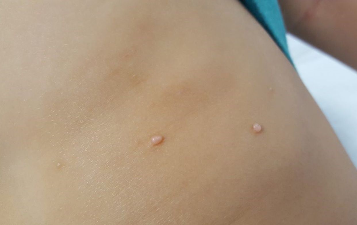 ¡Cuidado! No compartir toallas ni sentarse al borde de la piscina, para evitar el molusco contagioso