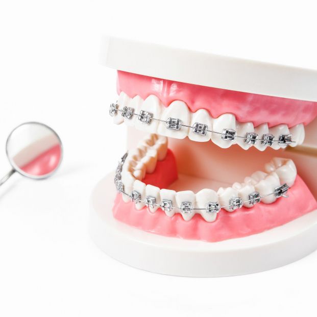 bigstock Tooth Model With Metal Wire De 263655142