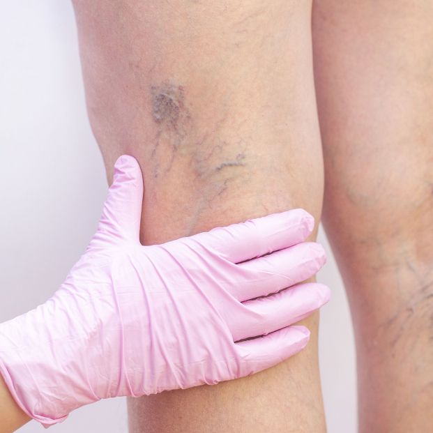 bigstock Female Legs With Varicose Vein 342577075