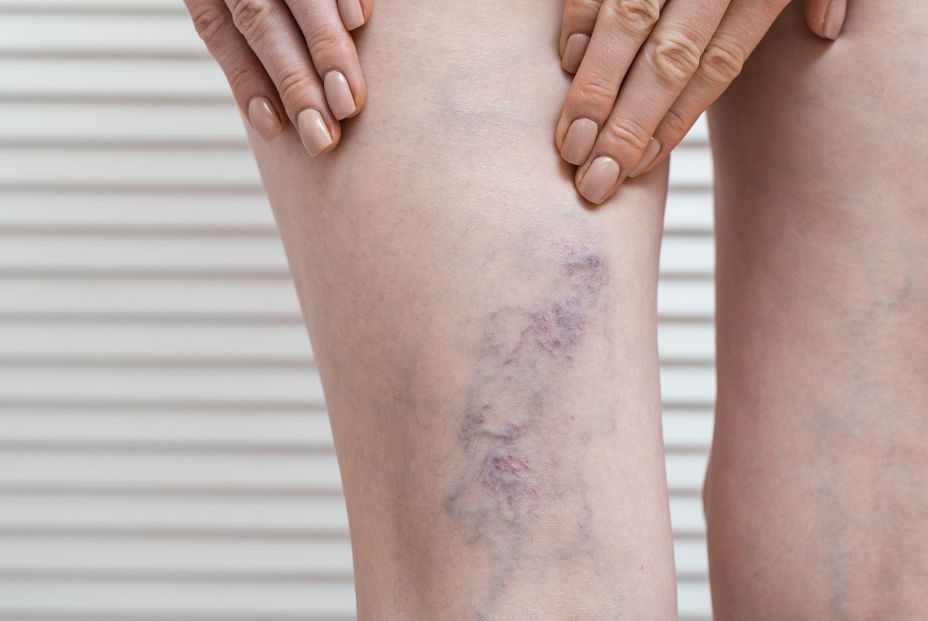 ¿Qué son realmente las varices y qué puedes hacer para prevenir su aparición? ¿Qué son realmente las varices y qué puedes hacer para prevenir su aparición?