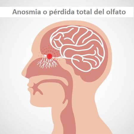 Anosmia o pérdida de olfato