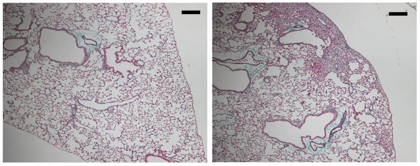 Fibrosis pulmonar. Foto: Europa Press Fibrosis pulmonar. Foto: Europa Press