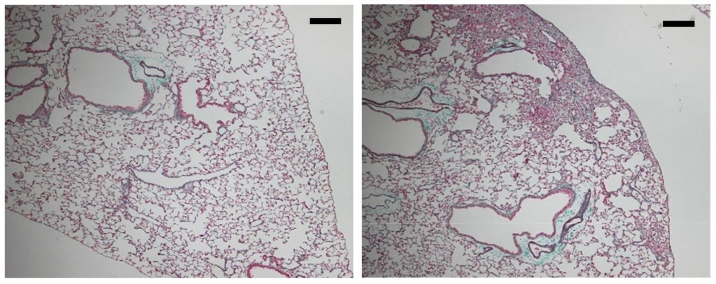 Fibrosis pulmonar. Foto: Europa Press