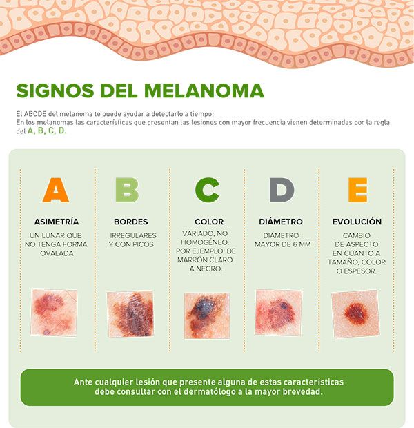 abcd melanoma