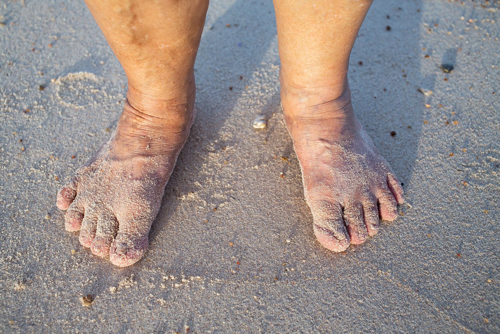 Consejos para que las varices no arruinen tu verano