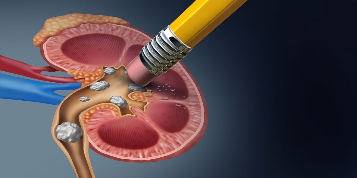Claves para evitar la aparición de piedras en el riñón