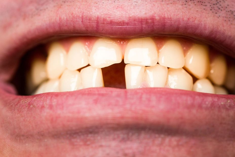 bigstock Yellow Bad Teeth Man Without  305227432