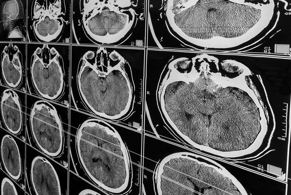 Investigadores españoles descubren una nueva alteración en el cerebro de las personas con Alzheimer