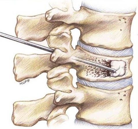 Elastoplastia