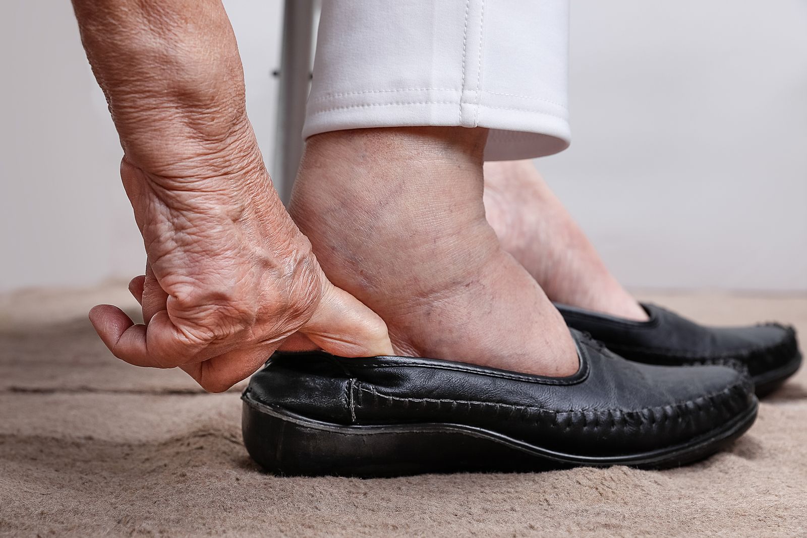 Relacionan la Fibromialgia con problemas en los pies: Juanetes, deformidades o pérdida de equilibrio