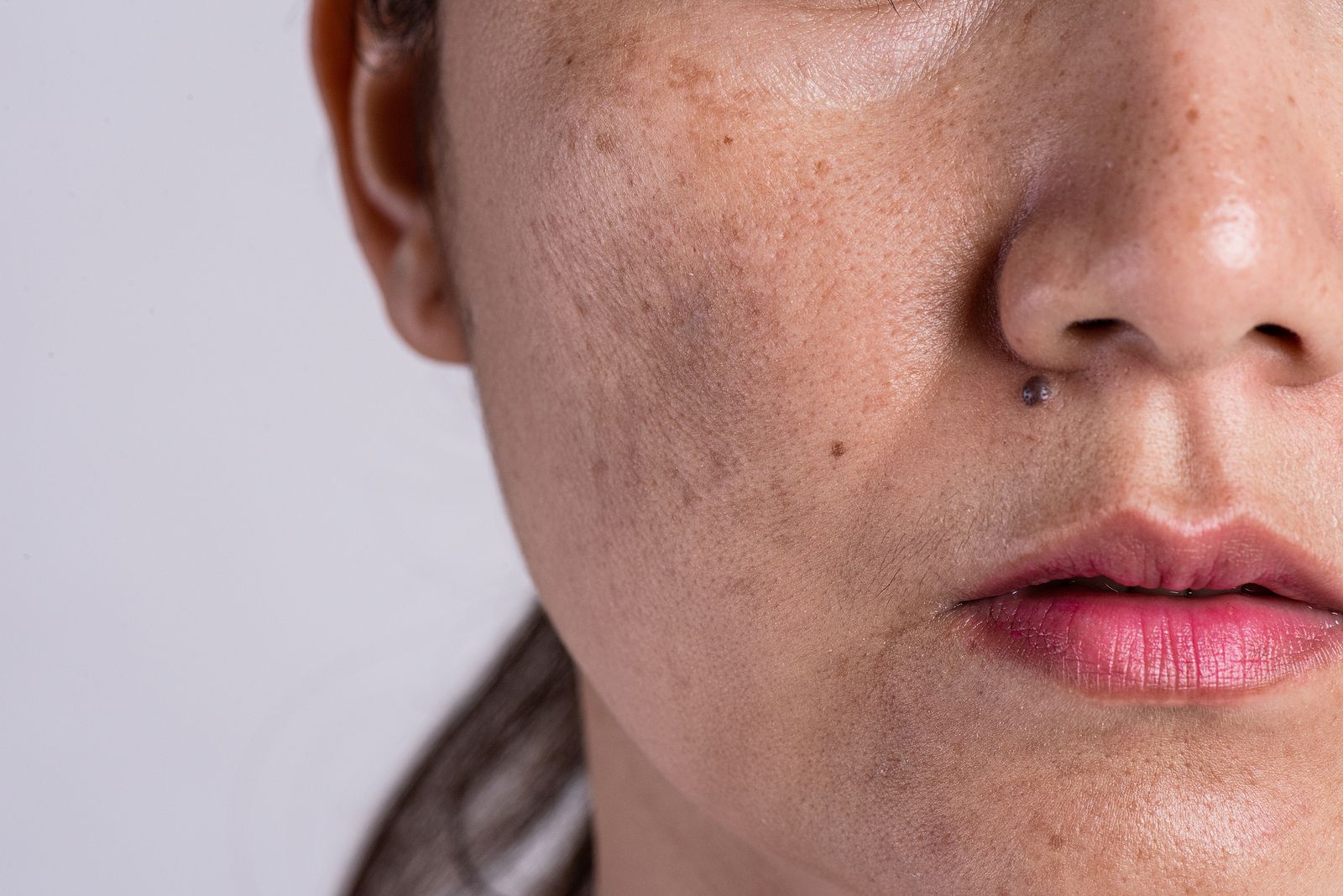 ¿Qué es el melasma? Conoce cómo podemos prevenirlo y tratarlo ¿Qué es el melasma? Conoce cómo podemos prevenirlo y tratarlo