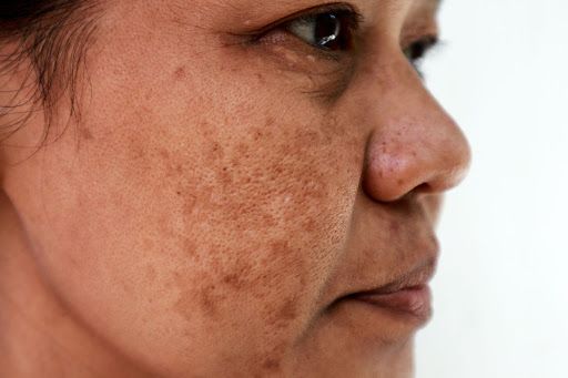 Melasma Melasma
