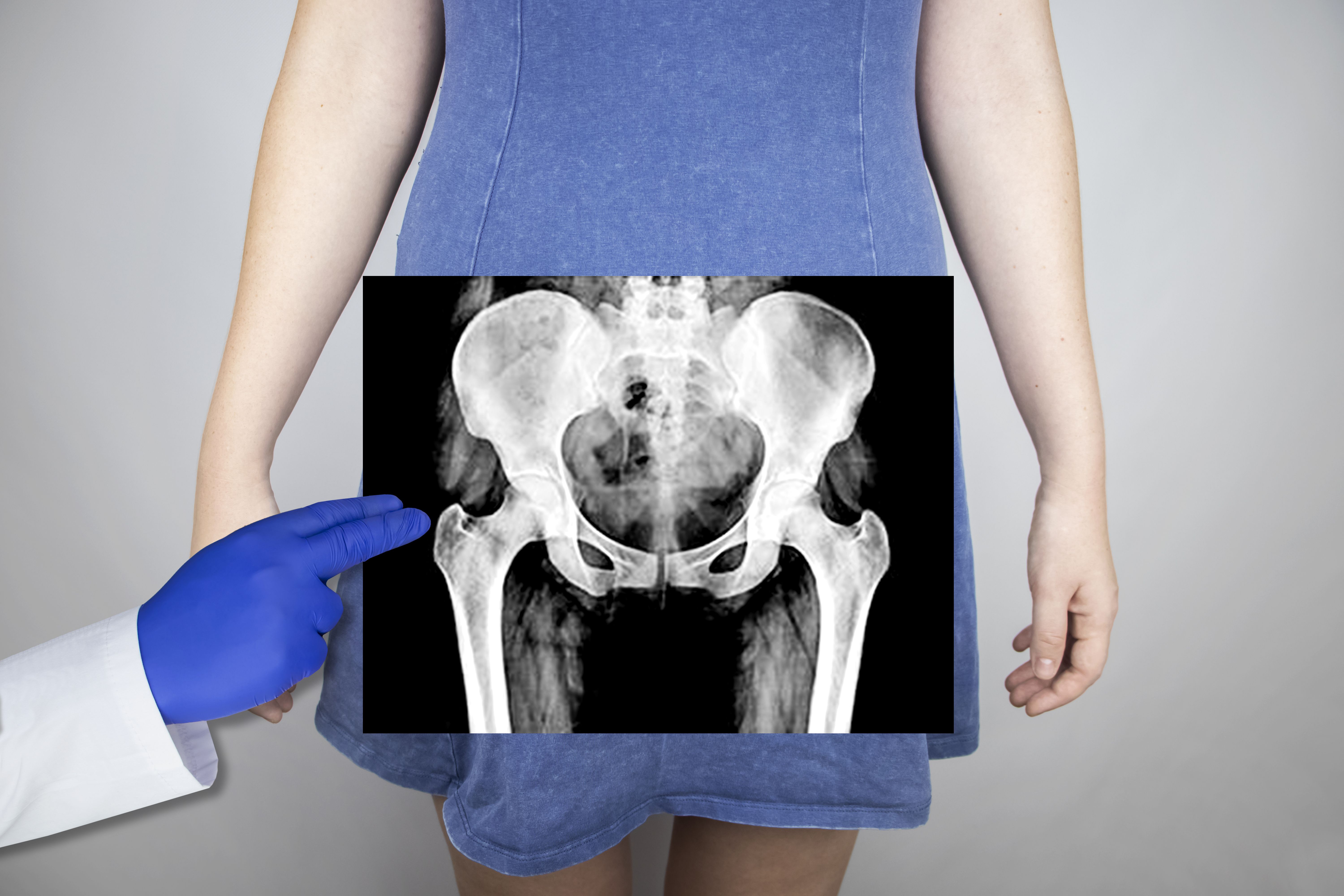 La osteoporosis, detrás de la mayoría de fracturas de cadera