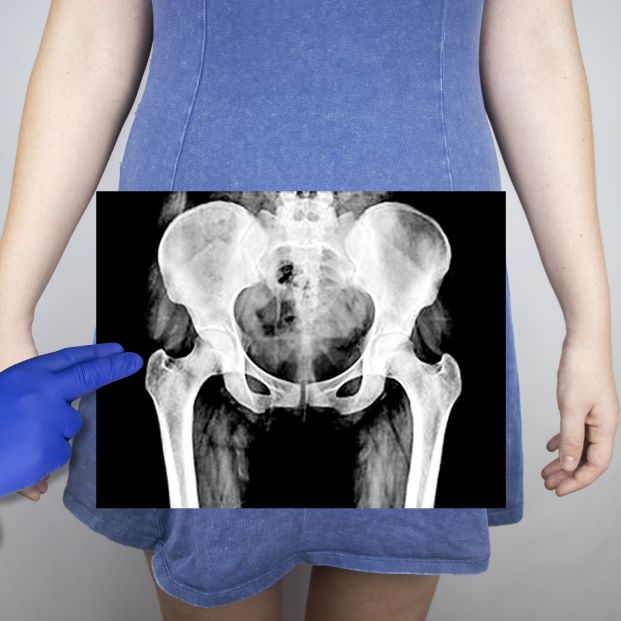 La osteoporosis, detrás de la mayoría de fracturas de cadera
