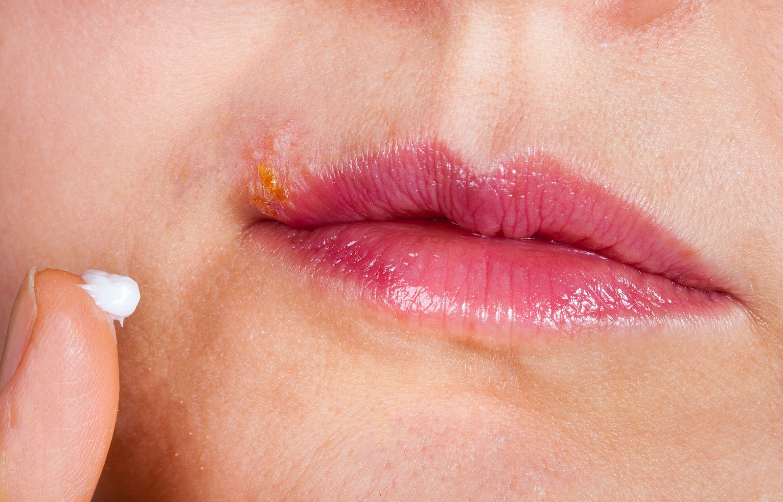 Herpes labial: ¿son eficaces las cremas y los parches?