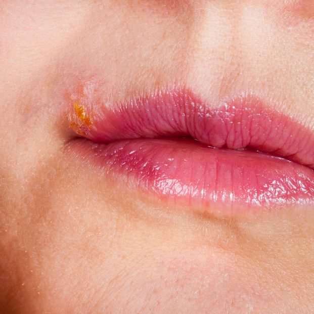 Herpes labial: ¿son eficaces las cremas y los parches?