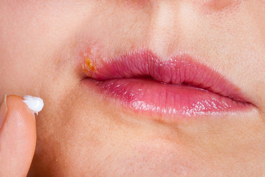 El virus del herpes labial puede provocar cambios similares al alzhéimer en neuronas humanas