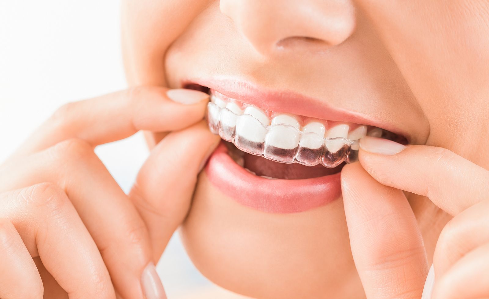 ¿Pensando en arreglar tus dientes? Estos son los tipos de ortodoncia existentes