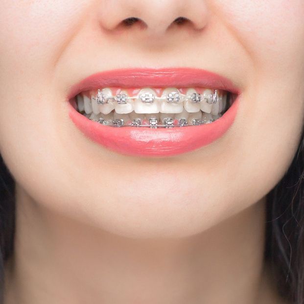 ¿Pensando en arreglar tus dientes? Estos son los tipos de ortodoncia existentes Foto: bigstock