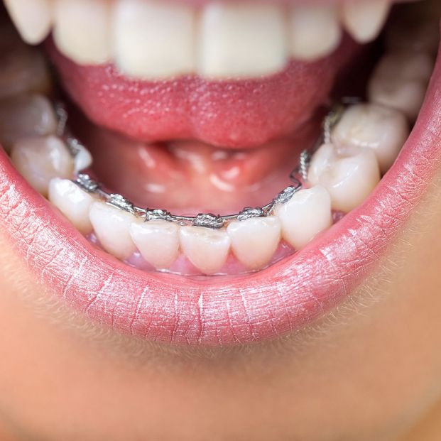 ¿Pensando en arreglar tus dientes? Estos son los tipos de ortodoncia existentes Foto: bigstock