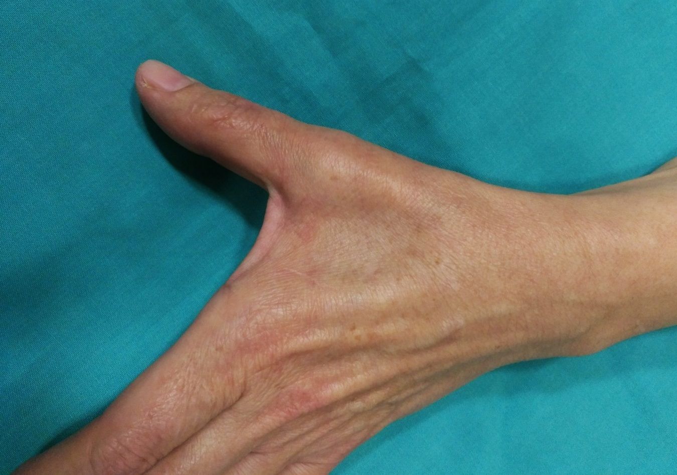 El Covid agrava "severamente" el síndrome del túnel carpiano y otros nervios de la mano