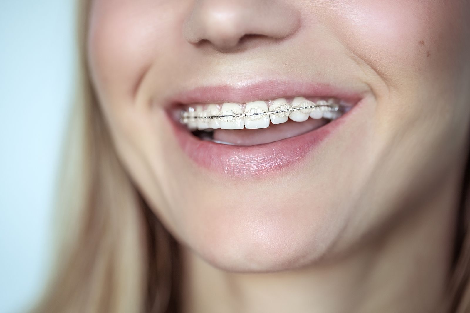 ¿Qué es la ortodoncia estética? Foto: bigstock