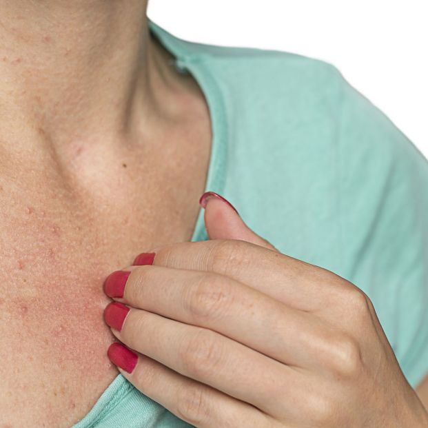 Urticaria, el síntoma que puede delatar a la anafilaxia (Foto Bigstock) 2