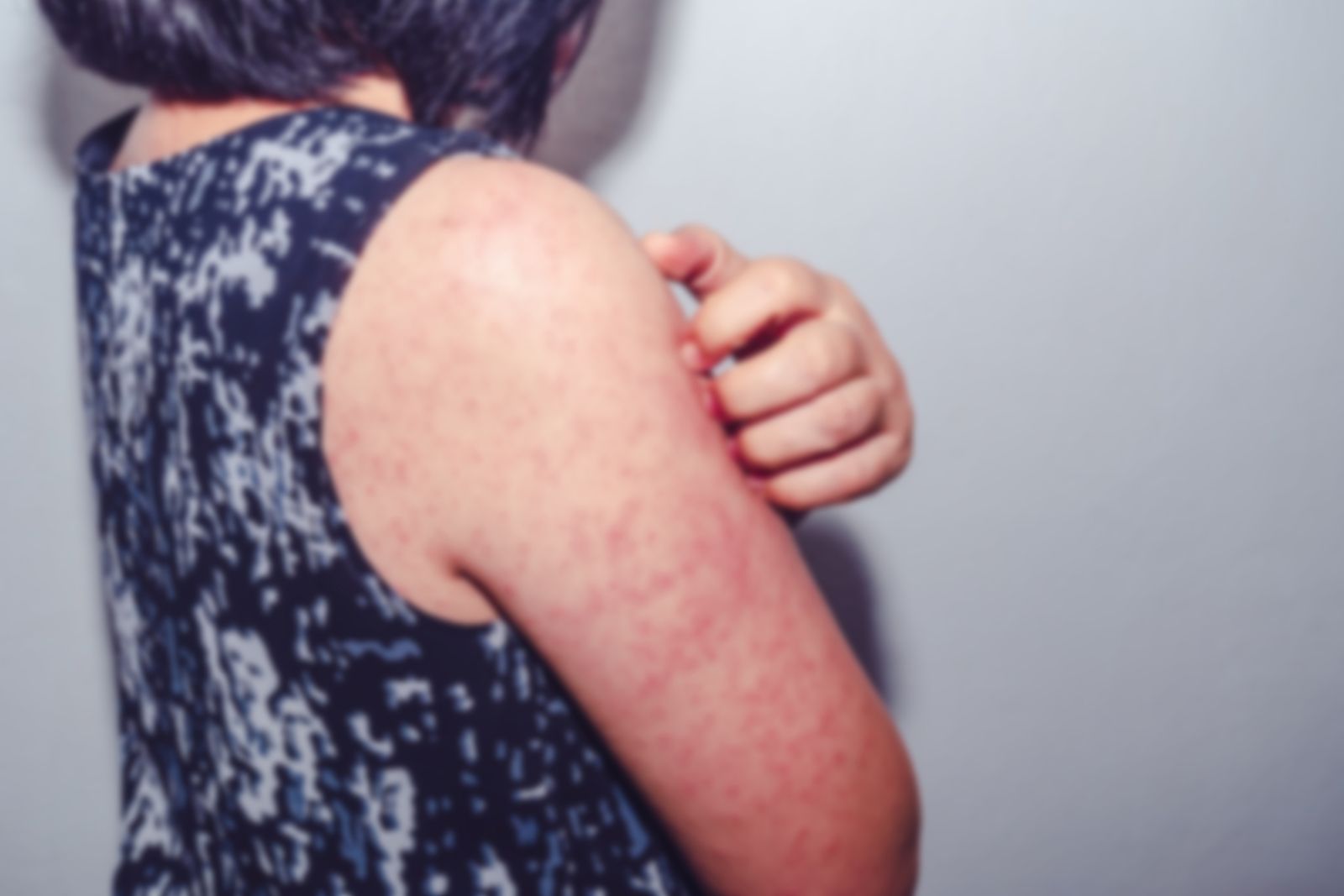 Urticaria, el síntoma que puede delatar a la anafilaxia (Foto Bigstock)