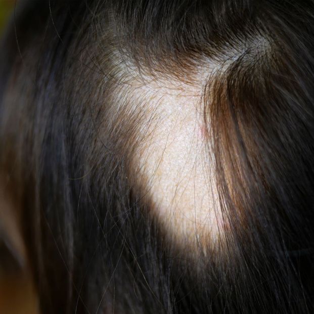 Principio de alopecia en mujeres ¿Cuándo detectarlo? Foto: bigstock