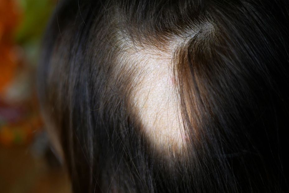 Principio de alopecia en mujeres ¿Cuándo detectarlo? Foto: bigstock