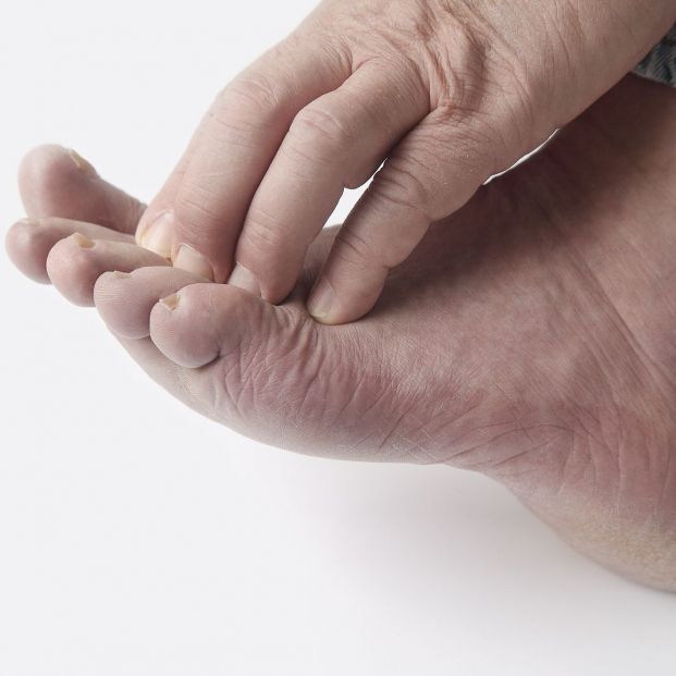 Sabañones en los pies: consejos de los expertos para evitar esta inflamación dolorosa en invierno (Foto: BigStock)