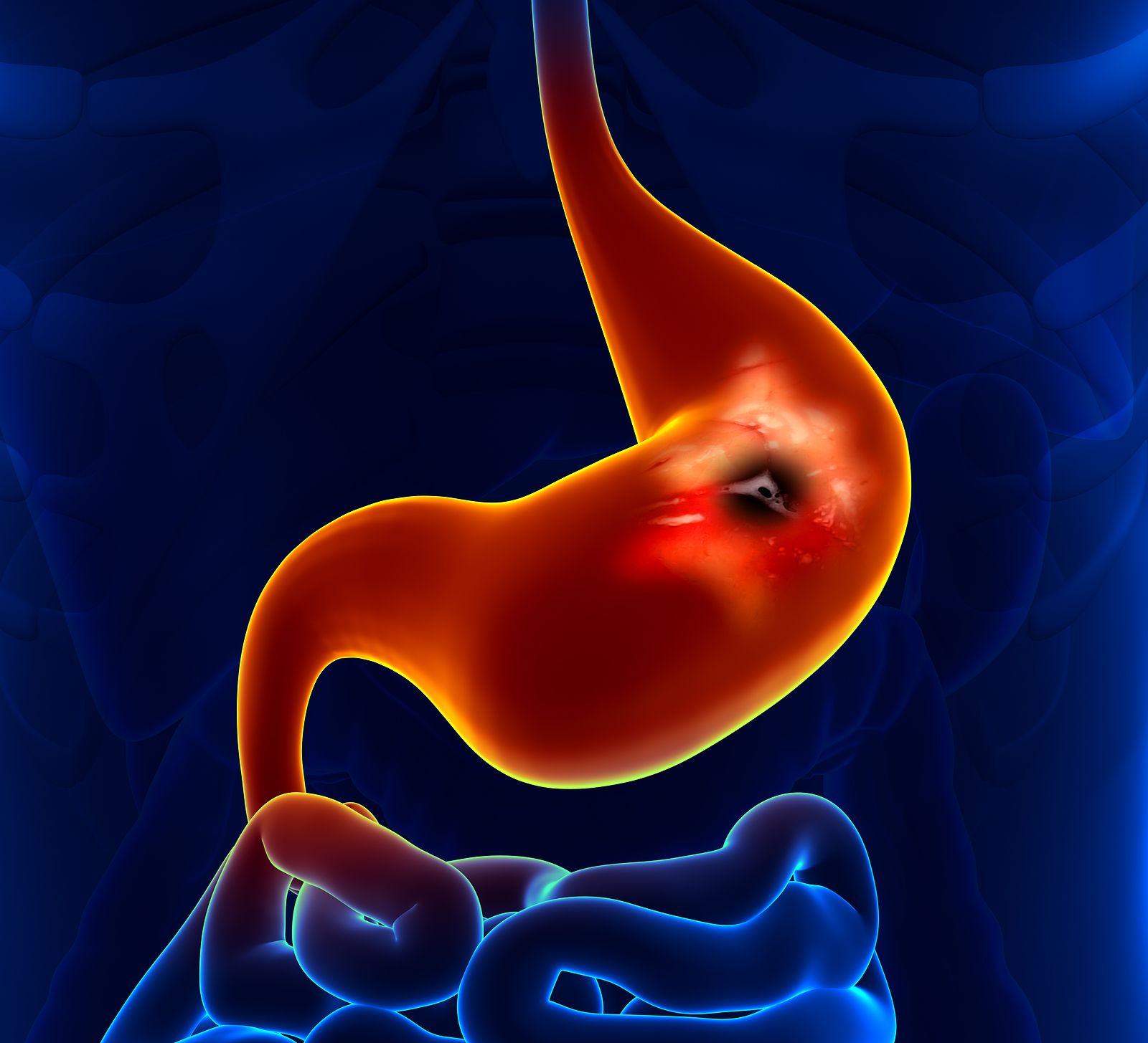 Síntomas que pueden indicar que se sufre una úlcera de estómago