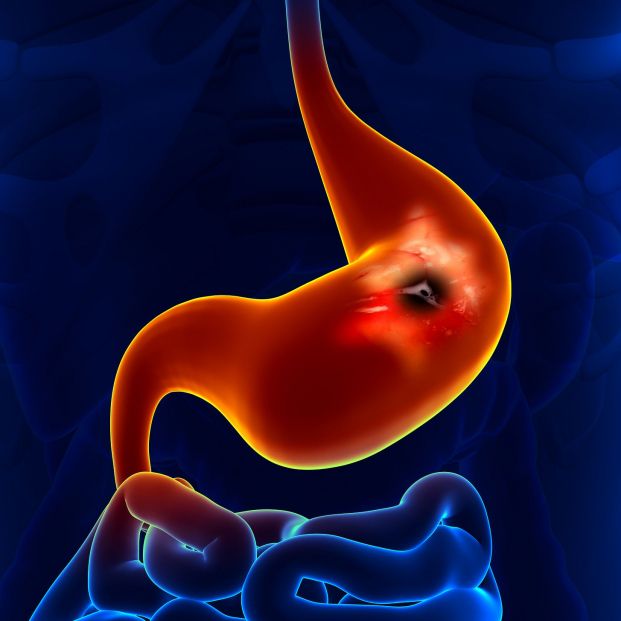 Síntomas que pueden indicar que se sufre una úlcera de estómago