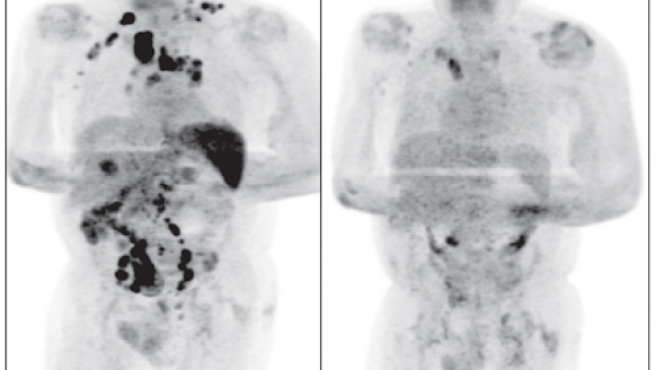 Comparación de la tomografía por emisión de positrones (PET) al inicio (izquierda) y después de meses infectado con SARS-CoV-2 (derecha). Foto  British Journal of Haemathology