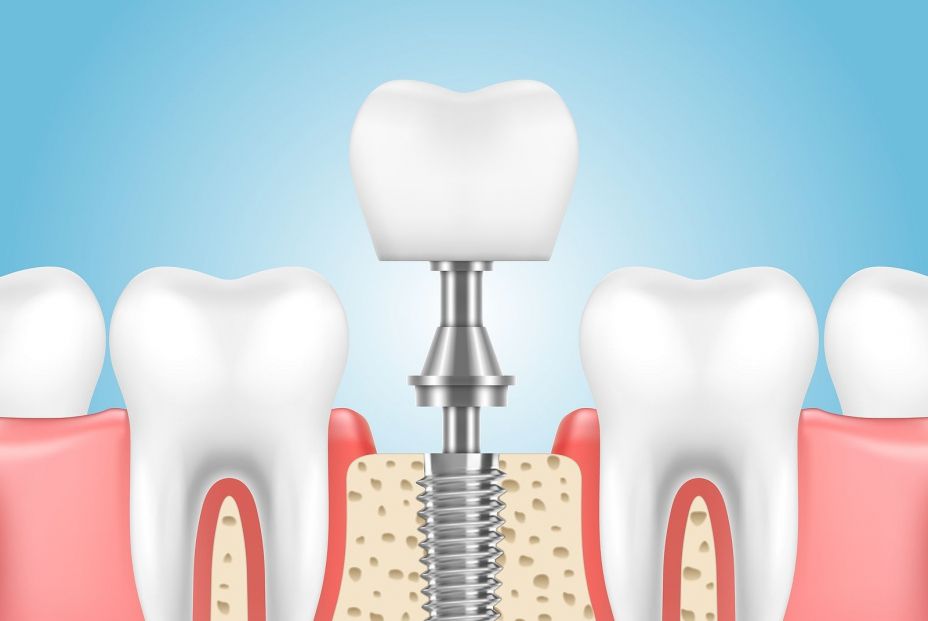 ¿Qué son las prótesis dentales? ¿Cuál debo elegir? (bigtstock)