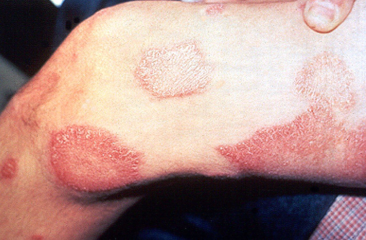¿Qué sabemos de la lepra?