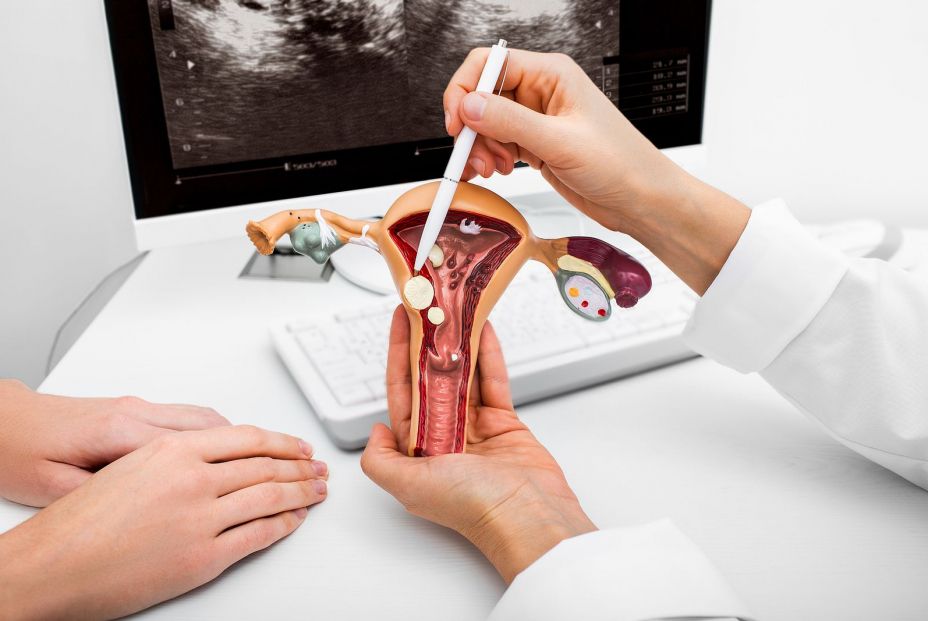 Miomatosis uterina: la causa más común de tumores pélvicos en mujeres (Bigstock) Miomatosis uterina: la causa más común de tumores pélvicos en mujeres (Bigstock)