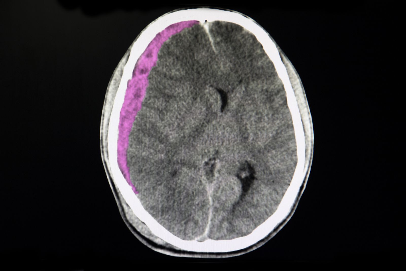 Qué es un hematoma subdural y cuáles son sus síntomas Foto bigstock Qué es un hematoma subdural y cuáles son sus síntomas Foto bigstock