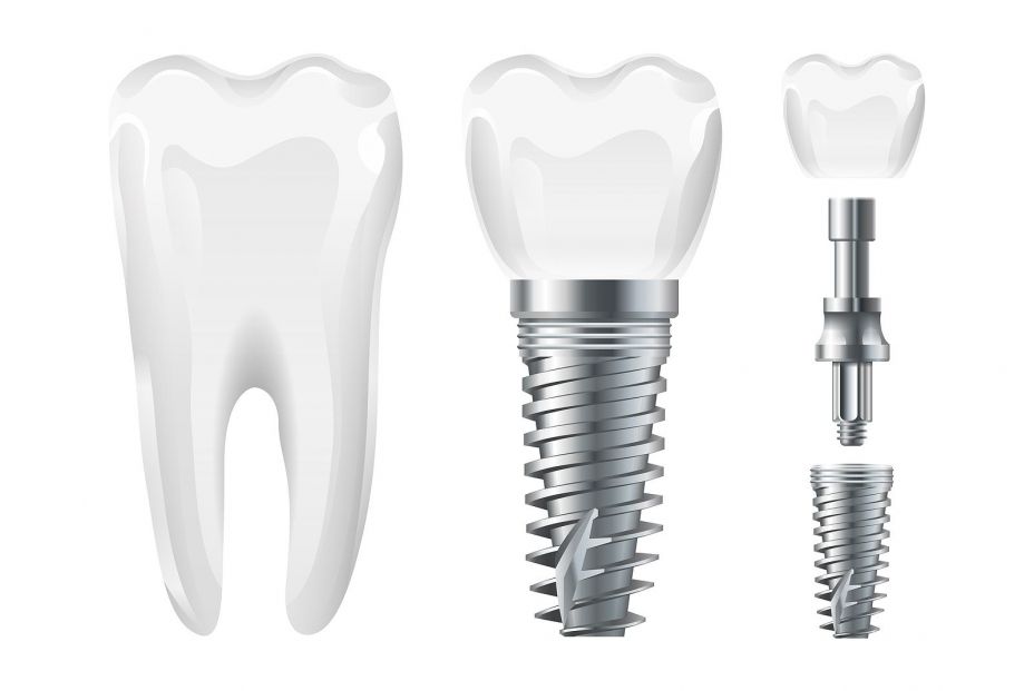 Ante la pérdida dentaria: ¿puente bucal o implante?. Bigstock