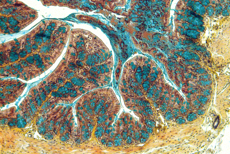 Nueva terapia para el tratamiento de la enfermedad inflamatoria intestinal Nueva terapia para el tratamiento de la enfermedad inflamatoria intestinal