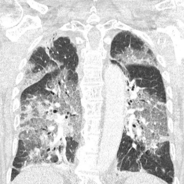 Radiografía de paciente ingresado por Covid-19