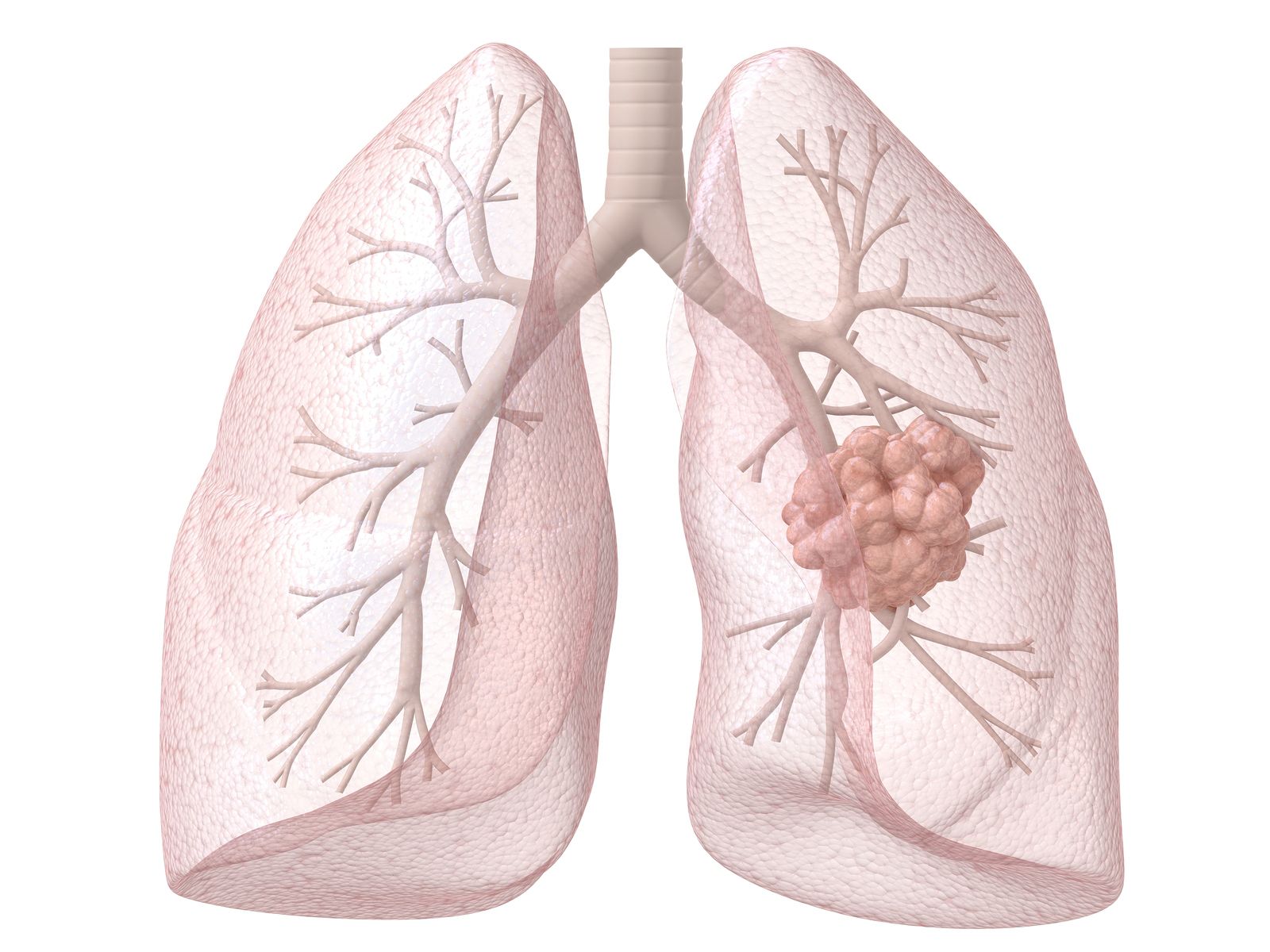 Un estudio muestra que el radón interior a dosis altas duplica el riesgo de cáncer de pulmón (Bigstock)