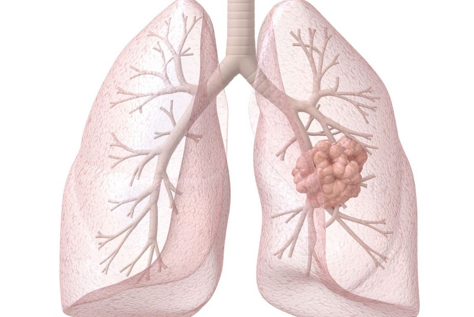 Un estudio muestra que el radón interior a dosis altas duplica el riesgo de cáncer de pulmón (Bigstock)