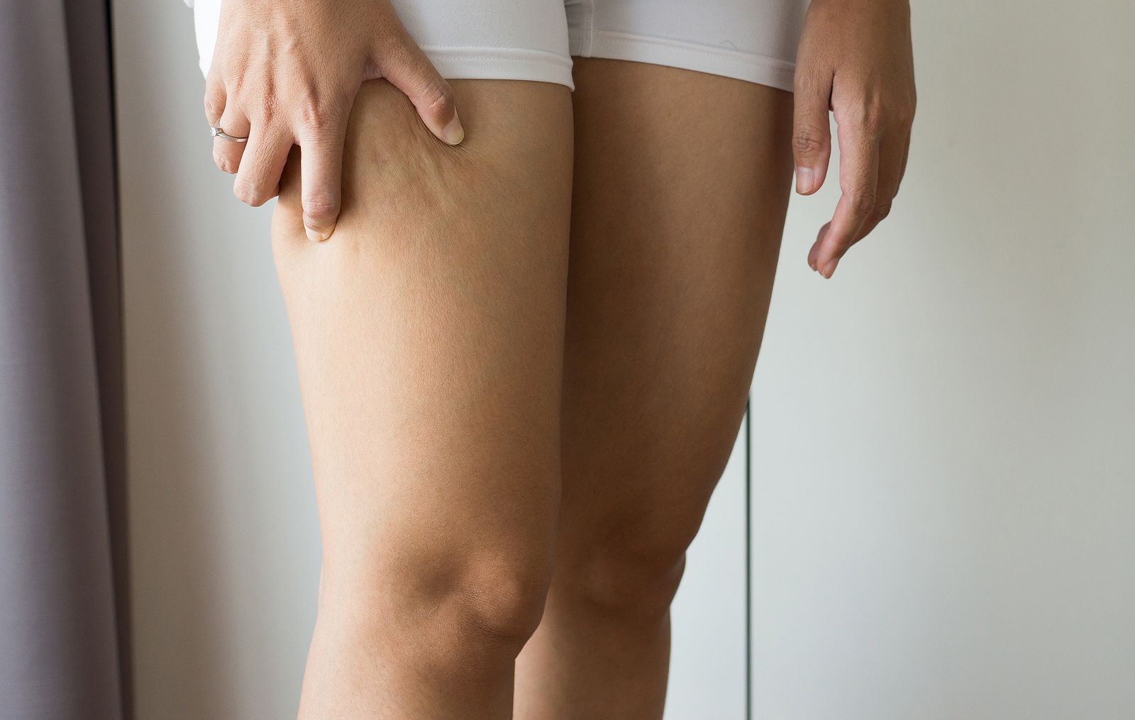 Qué es el lipedema y por qué es más común en mujeres (Bigstock) Qué es el lipedema y por qué es más común en mujeres (Bigstock)