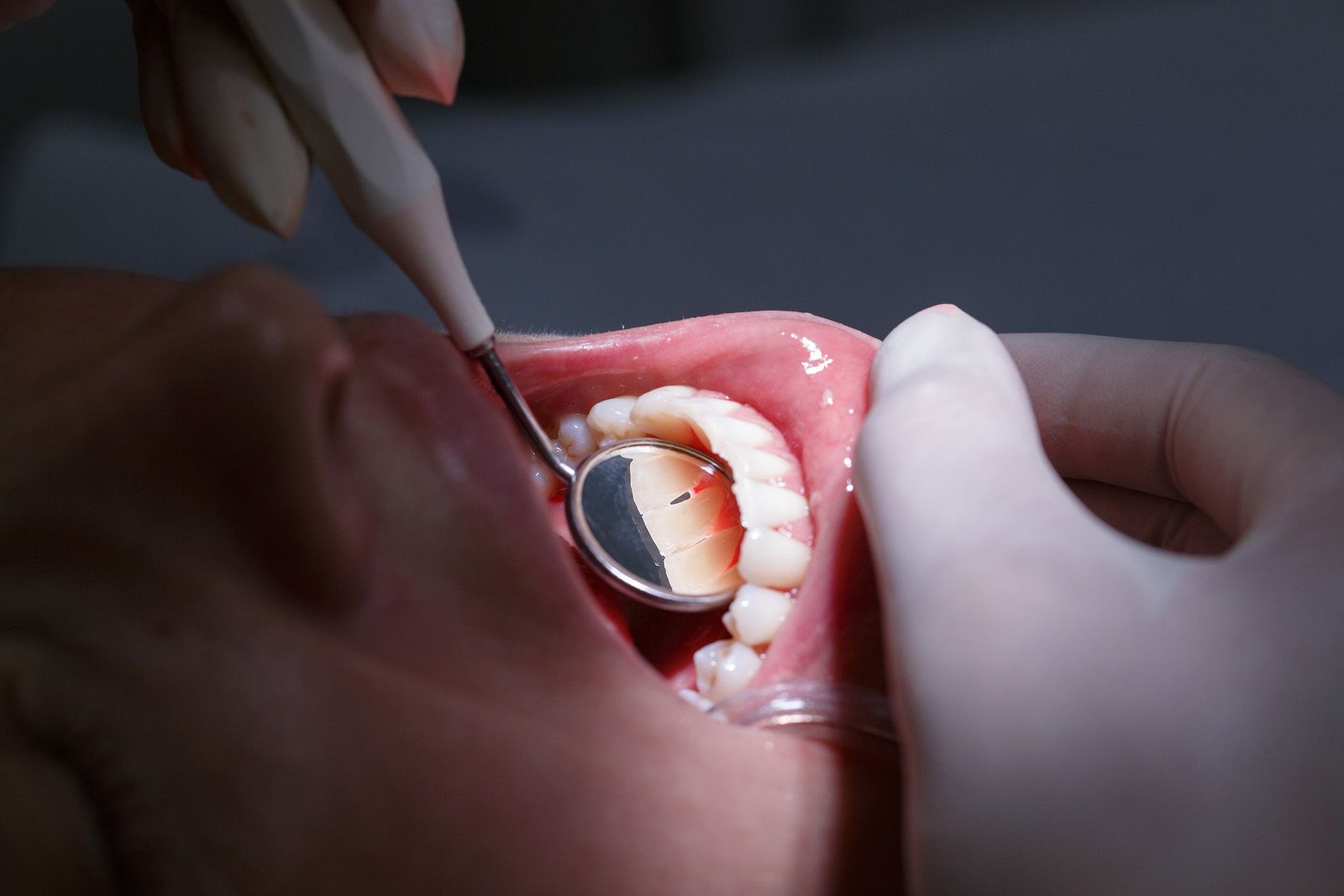 Vigila tus encías si sangran porque puede ser síntoma de enfermedad periodontal (Bigstock)