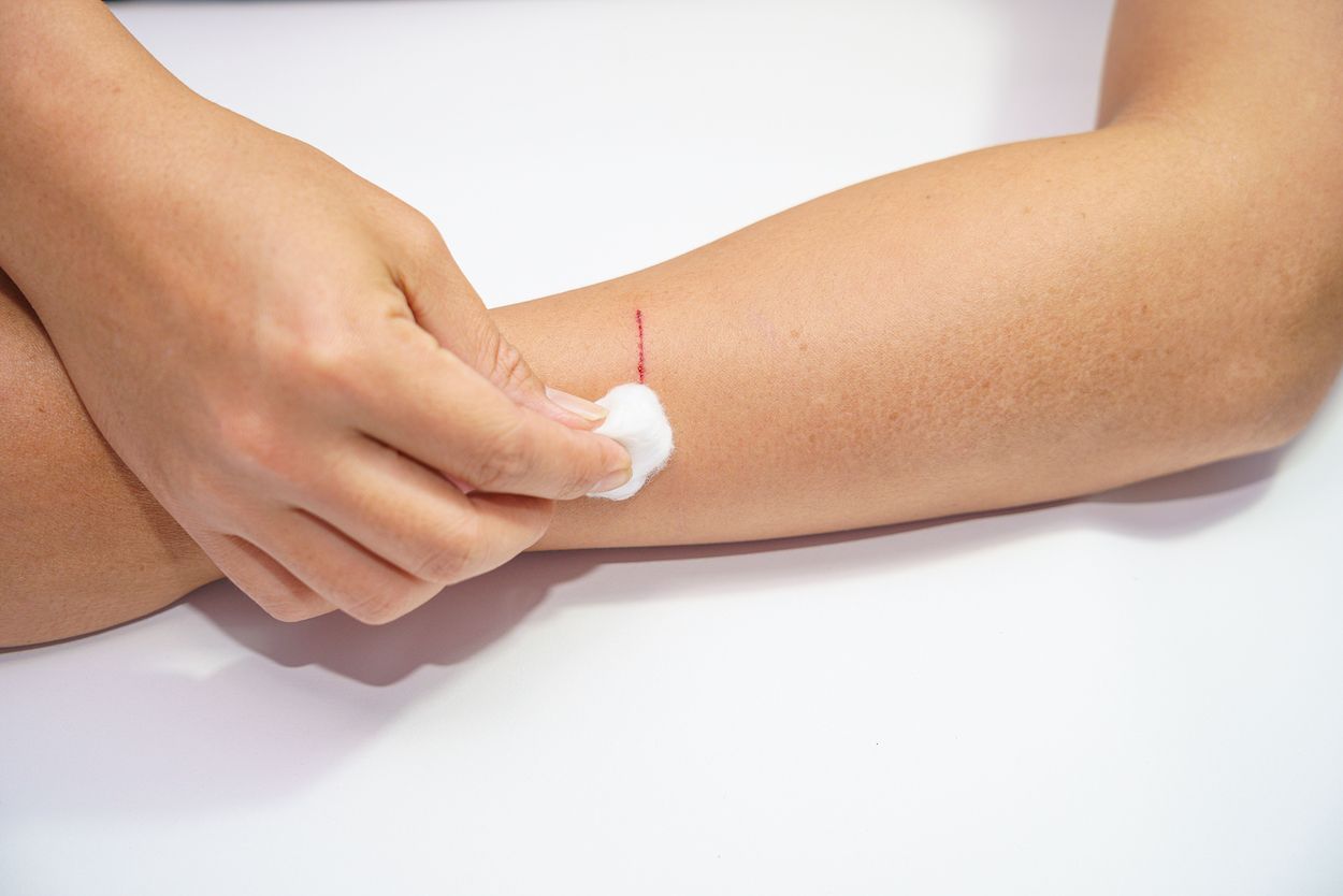 Cómo curar una herida para que no deje cicatriz