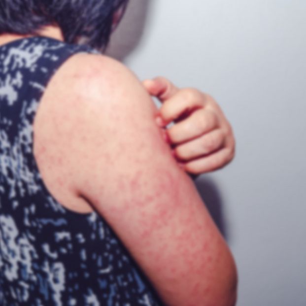 Alertan del aumento de casos de urticaria alérgica por culpa de picaduras de insectos 