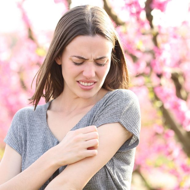 Aceite casero para aliviar las picaduras Foto: bigstock