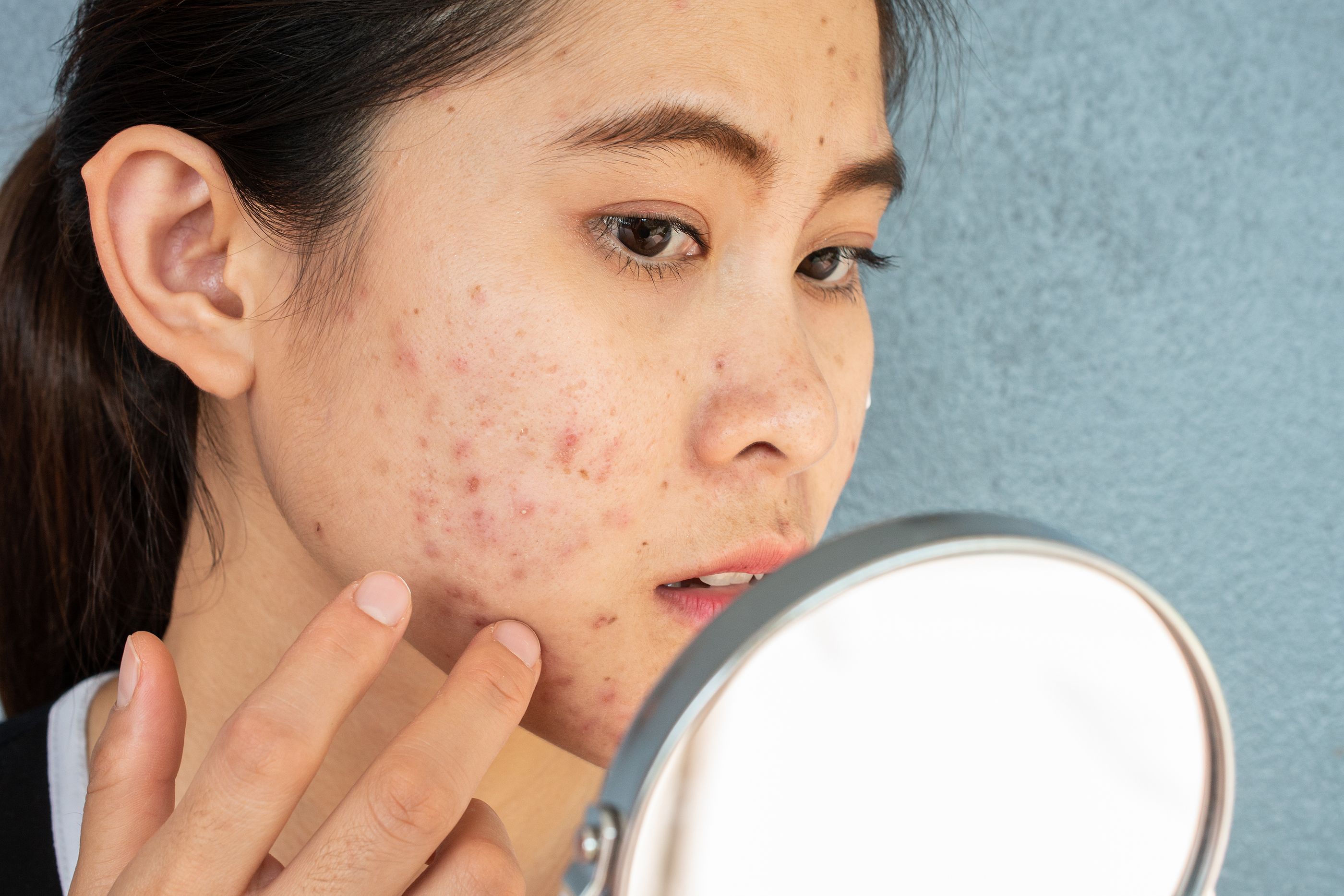 La pesadilla del acné. Foto: Bigstock