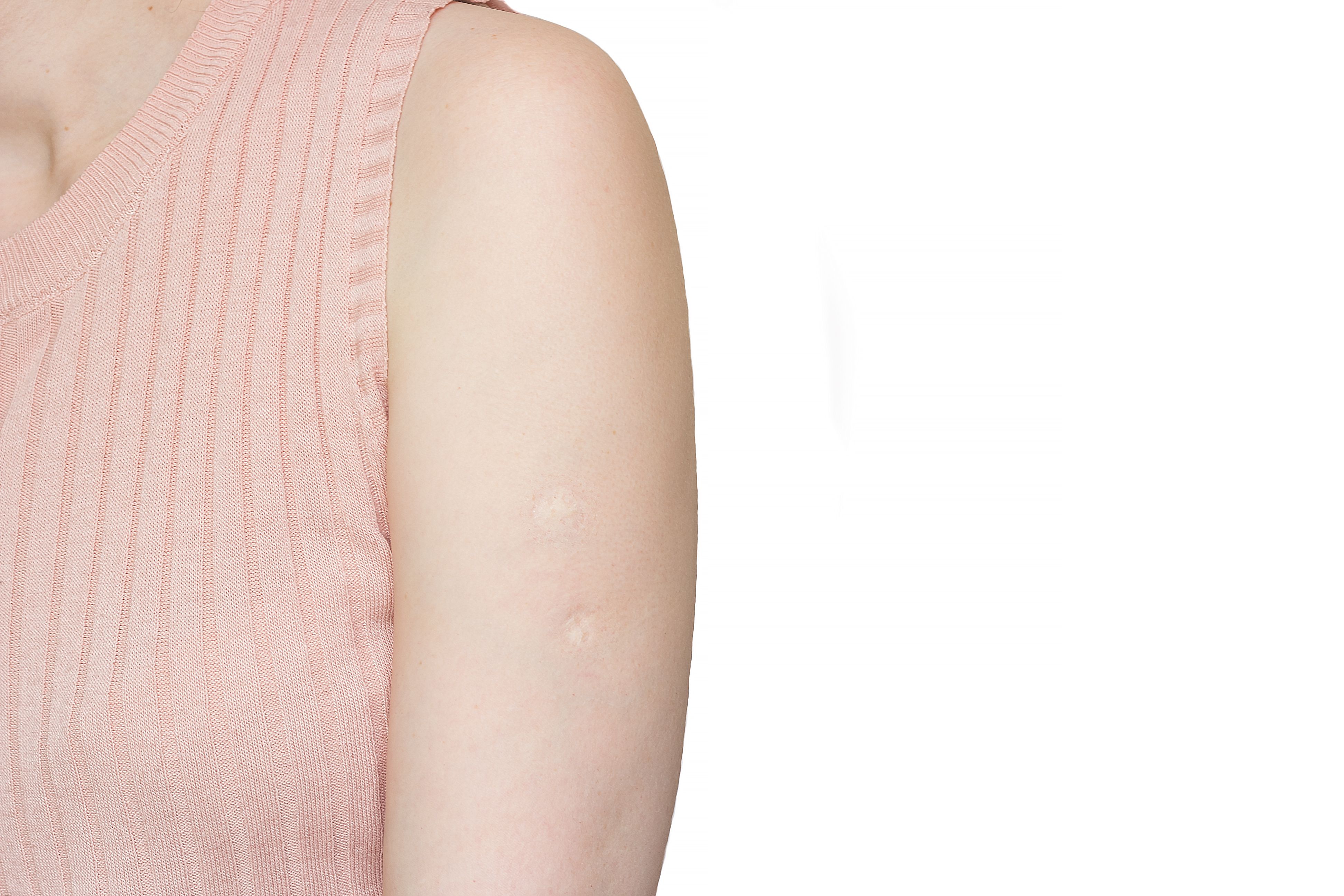La marca de una generación: ¿Te acuerdas de qué era la vacuna que dejaba esta cicatriz en el brazo?